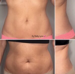 Before and after results of cavitation